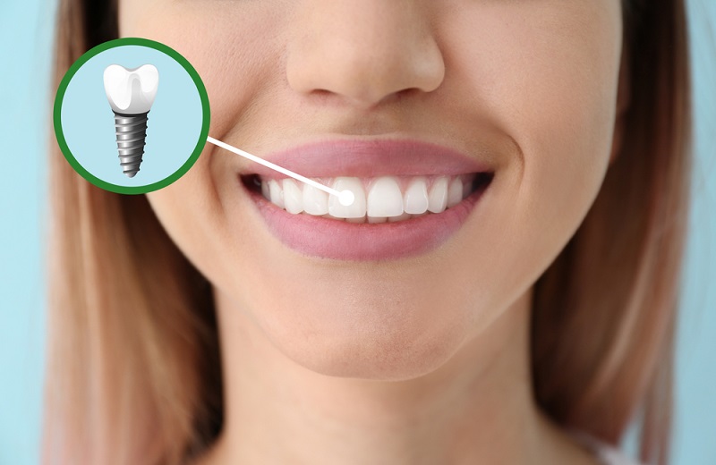 Cum sa ai grija de implantul dentar dupa procedura: 5 recomandari