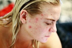 Suferi de acnee? Iata 3 motive ca sa consulti un dermatolog